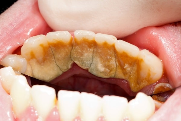 diş tartarı neden olur